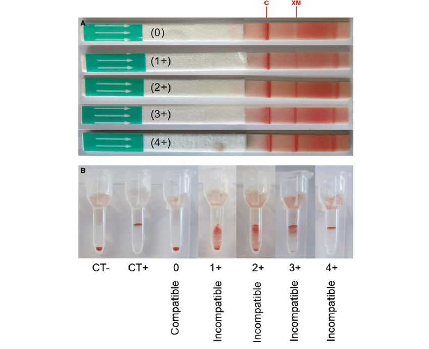 https://www.researchgate.net/publication/319110344/figure/fig4/AS%3A667765287440416%401536219059977/Example-of-different-cross-match-test-results-with-the-direct-antiglobulin-enhanced.png